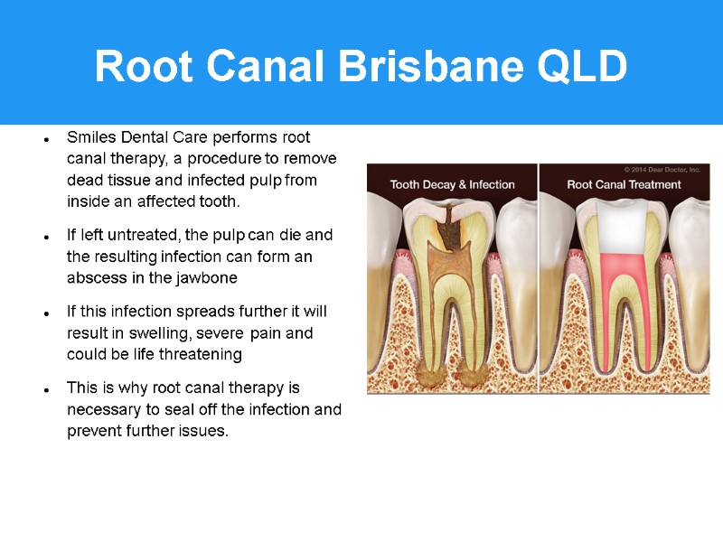 Root Canal Brisbane QLD Smiles Dental Care performs root canal therapy, a procedure to